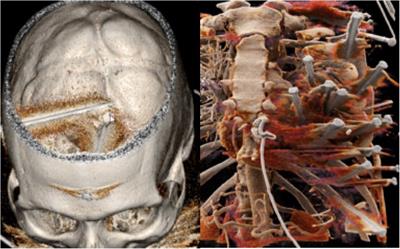 Case report: Eighteen nails gun shots in the head, thorax and abdomen but still conscious at admission: A challenging patient for the cardiac surgeon!